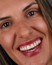 A transformação de hoje ✨FALA POR SI!✨ Facetas em resina estratificadas,  planejadas detalhe por detalhe, respeitando forma, cor e naturalidade.  Quando técnica, olhar clínico e bom senso se encontram, o resultado é