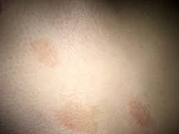 Braune Raue Flecken Auf Der Haut