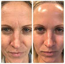 Hydrafacial Cost An Effective Facial The L A Glow Facial Before And After Skin Aesthetics Hydra Facial