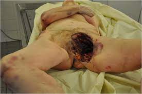 Kostic v, dragasevic n, stemac n, filipovic s. Sudden Unexpected Death Due To Fournier Gangrene Springerlink