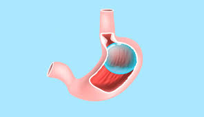 Gastric Balloon - Doç. Dr. Edip Erdal Yılmaz