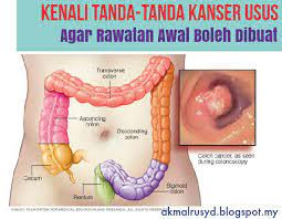 Dan katanya beliau memang mengidap kanser usus tahap 4. Meremang Bulu Roma Bila Mak Mertua Kawan Sembuh Kanser Usus Tahap 4
