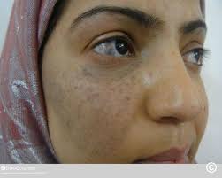Image result for Diffuse Hyperpigmentation