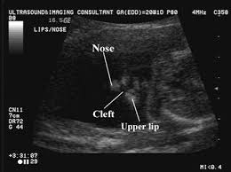 Ultrasound Of Cleft Lip And Palate Cleft Lip Cleft Lip And Palate Ultrasound Sonography