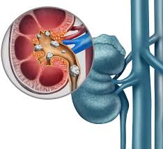 Potassium Citrate Improves Long Term Outcomes In Patients With Uric Acid Stones Uf Health University Of Florida Health