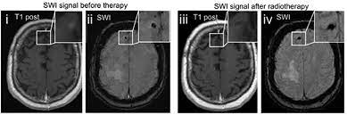 To connect a switch to another switch, follow these steps. Frontiers Clinical Value Of Susceptibility Weighted Imaging Of Brain Metastases Neurology