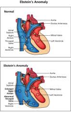 Thomas Heart Condition Ebstein S Anomaly Anomaly Heart Conditions