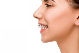 Most overbites are the result of genetics, heredity, and the natural process of growing our first teeth. Overjet Teeth What Does It Look Like And How To Treat Them