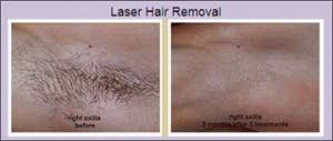 Additionally a chiller is used to blow cold air onto the treated area, further protecting the skin. Best Laser Hair Removal Encino Bakersfield Sean Younai Md