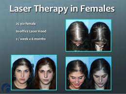 Low level laser treatments' regenerative effects. Treating Hair Loss W Low Level Laser Therapy Emaa 2012 Paris