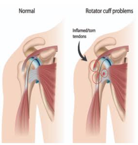 Shoulder Therapy