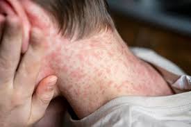 Image result for Measles