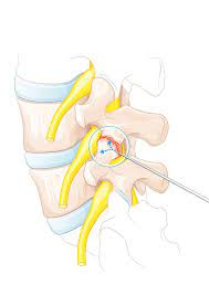 Therapeutische Infiltration An Der Wirbelsaule Schulthess Klinik