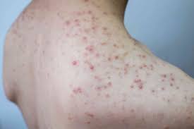 Image result for Skin Infection