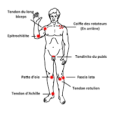 La douleur part de sous la partie interne du genou et irradie le long de la jambe. La Tendinite Konrad Florkow Osteopathe A Castres