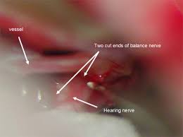 Meniere S Disease Eastern Virginia Medical School Evms Norfolk Hampton Roads