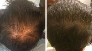 Leyden j, dunlap f, miller b, et al (1999) finasteride in the treatment of men with frontal male pattern hair loss. Pin On Hooded
