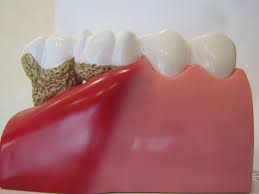 Dentoform Model Comparison Of Periodontal Disease Vs Healthy Gingiva Dental Pictures Periodontitis Periodontal Disease