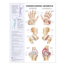 09 31 9877 Understanding Arthritis Chart