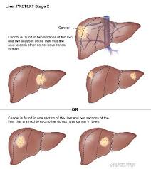The most common of these is bile duct carcinoma. Liver Cancer In Children Causes Symptoms Diagnosis And Treatment St Louis Childrens Hospital