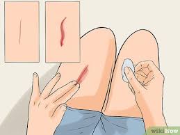 Size as a determining factor the size of your laceration is an important indicator of whether it needs stitches. How To Determine If A Cut Needs Stitches 9 Steps With Pictures