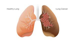 Image result for Lung Cancer