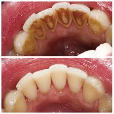 Maybe you would like to learn more about one of these? The Importance Of Professional Teeth Cleaning Oral Hygiene