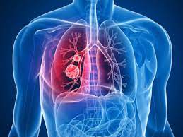 La embolia pulmonar es una obstrucción en una de las arterias de los pulmones. Que Es Un Tromboembolismo Pulmonar Salud Y Cardiologia