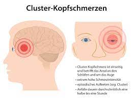 Was Sind Cluster Kopfschmerzen