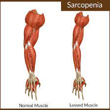 Relationship between sarcopenia and electrocardiographic abnormalities in older people: Sarcopenia Causes Consequence Treatment Prevention