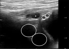 Image result for Inguinal hernia child