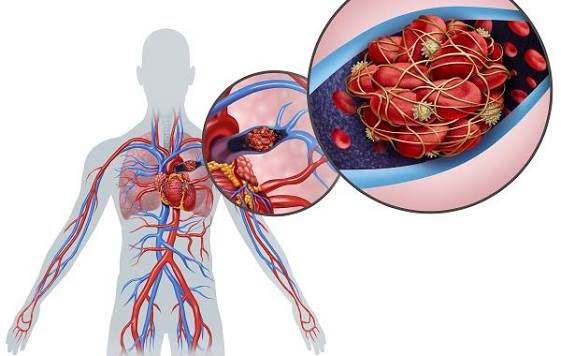 Thuyên tắc phổi: Triệu chứng, nguyên nhân và cách điều trị
