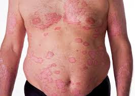 A gravidade é variável, desde manchas pequenas e localizadas até ao revestimento total do corpo. Psoriase O Que E Psoriase E O Que Eu Preciso Entender Dela Sumred