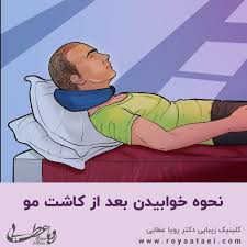 فیلم و عکس کندن دلمه های کاشت مو