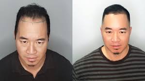 The finished effect is a natural cropped or shaved hair style with a new hairline. This Hair Tattoo Artist Is Inking Bald People S Heads To Fight Hair Loss