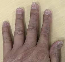 Image result for Beau lines feet