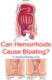 Pin On Hemorrhoid Relief