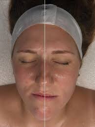 ✨ Lymphatic Drainage = Instant Sculpt + Glow ✨ The left side of both  pictures shows where lymphatic drainage massage was performed — notice how  the features look more sculpted, lifted, and