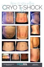 The cryo t shock is cryogenic and thermogenic treatment to remove cellulite and undesired fat. Cryo T Shock Cryospa Iowa