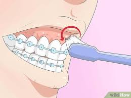 Read on for more information. How To Make Your Braces Hurt Less With Pictures Wikihow