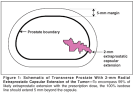 Although screenings for prostate cancer are one tool for early detecti. Permanent Prostate Brachytherapy Is Supplemental External Beam Radiation Therapy Necessary