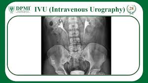 Image result for Intravenous Pyelogram