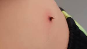 Check spelling or type a new query. Faut Il S Inquieter Des Tiques Et De La Maladie De Lyme En Abitibi Temiscamingue Radio Canada Ca