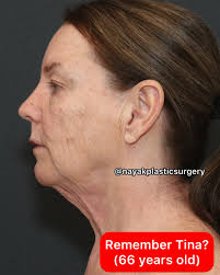 Perde 50 quilos, faz um lifting e ninguém acreditou que fosse a mesma. Veja  o antes e depois