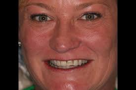 Dental Bridges & Crowns