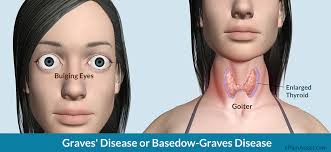 Beberapa gangguan yang bisa terjadi pada kelenjar tiroid : Apa Yang Dimaksud Dengan Penyakit Grave Atau Grave S Disease Ilmu Kedokteran Dictio Community