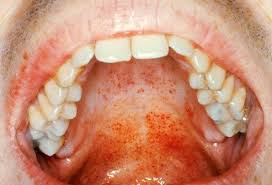 Intertrigo may present as diaper rash in children. Viral Skin Conditions Pictures Of Rashes Blisters And Sores In Adults And Toddlers