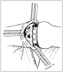 Ferrara a., ruggiero r., boccia g. Intestinal Anastomosis With The Biofragmentable Anastomosis Ring Sciencedirect