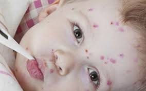 Cu ce complicatii poate fi asociat varsatul de vint? Varicela La Copii Varicela La Adulti