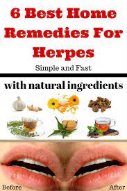 Pin On Cure For Herpes